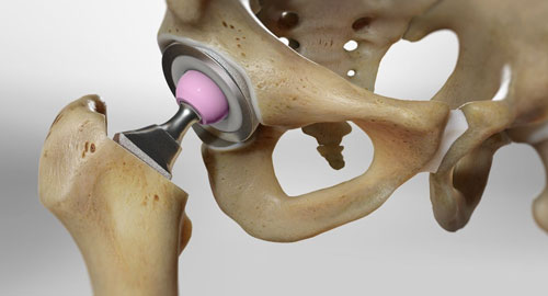 Hip Replacement Surgery