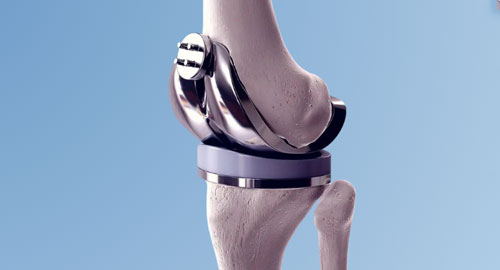 Revision Joint Replacement