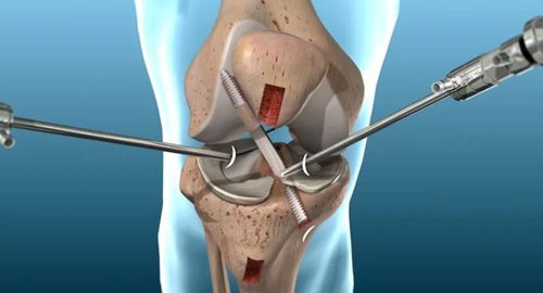 Knee Arthroscopy