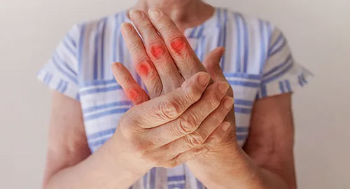 Arthritic Disorders